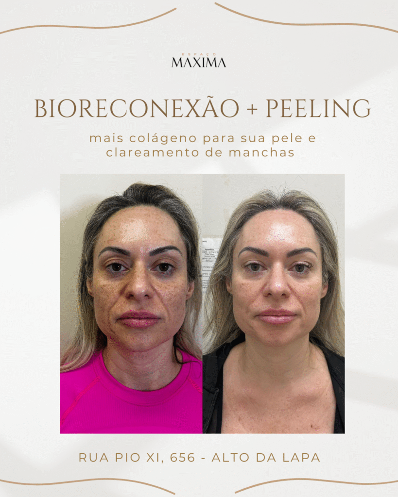 clareamento de manchas resultado